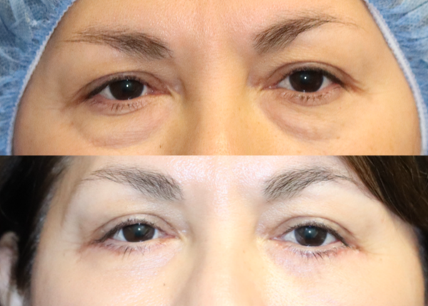 Lower Bleph before:after